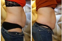 11-Cryo-zsirfagyasztas-fogyas-Diana-szepsegstudio-Dunaharaszti