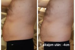 11-Cryotec-zsirfagyasztas-Diana-Szepsegstudio-Dunaharaszti