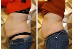 12-Cryo-zsirfagyasztas-fogyas-Diana-szepsegstudio-Dunaharaszti