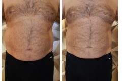 12-Cryotec-zsirfagyasztas-Diana-Szepsegstudio-Dunaharaszti