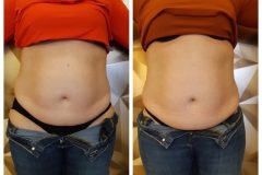 13-Cryo-zsirfagyasztas-fogyas-Diana-szepsegstudio-Dunaharaszti