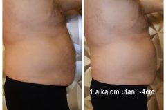 13-Cryotec-zsirfagyasztas-Diana-Szepsegstudio-Dunaharaszti