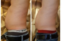 14-Cryo-zsirfagyasztas-fogyas-Diana-szepsegstudio-Dunaharaszti