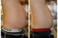 15-Cryo-zsirfagyasztas-fogyas-Diana-szepsegstudio-Dunaharaszti