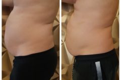 15-Cryotec-zsirfagyasztas-Diana-Szepsegstudio-Dunaharaszti