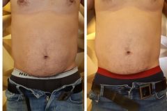 16-Cryo-zsirfagyasztas-fogyas-Diana-szepsegstudio-Dunaharaszti