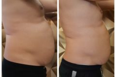 16-Cryotec-zsirfagyasztas-Diana-Szepsegstudio-Dunaharaszti