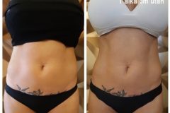 17-Cryotec-zsirfagyasztas-Diana-Szepsegstudio-Dunaharaszti