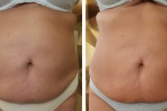 18-Cryo-zsirfagyasztas-fogyas-Diana-szepsegstudio-Dunaharaszti