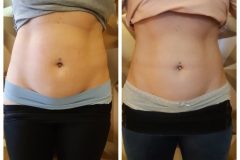 18-Cryotec-zsirfagyasztas-Diana-Szepsegstudio-Dunaharaszti