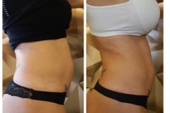 19-Cryotec-zsirfagyasztas-Diana-Szepsegstudio-Dunaharaszti