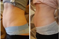 20-Cryotec-zsirfagyasztas-Diana-Szepsegstudio-Dunaharaszti