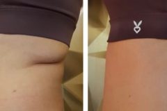 21-Cryo-zsirfagyasztas-fogyas-Diana-szepsegstudio-Dunaharaszti