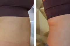 22-Cryo-zsirfagyasztas-fogyas-Diana-szepsegstudio-Dunaharaszti