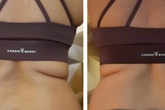 23-Cryo-zsirfagyasztas-fogyas-Diana-szepsegstudio-Dunaharaszti