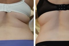 24-Cryotec-360-zsirfagyasztas-fogyas-Diana-szepsegstudio-Dunaharaszti