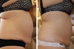 Zsirfagyasztas-Diana-Szepsegstudio-Dunaharaszti-14