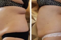 Zsirfagyasztas-Diana-Szepsegstudio-Dunaharaszti-15