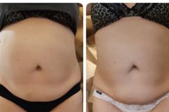 Zsirfagyasztas-Diana-Szepsegstudio-Dunaharaszti-16