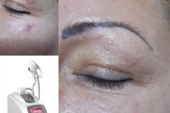 IPL-Rozacea-kezeles-Diana-Szepsegstudio-Dunaharaszti-15