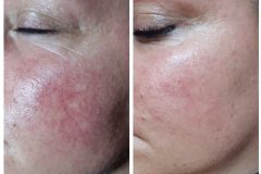 rosacea-kezeles-Dunaharaszti-Diana-Szepsegstudio-11