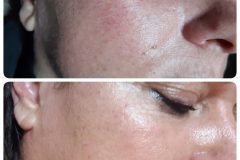 rosacea-kezeles-Dunaharaszti-Diana-Szepsegstudio-13