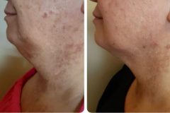 Monoshape-kezeles-Diana-Szepsegstudio-Dnaharaszti-111