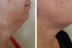 Monoshape-kezeles-Diana-Szepsegstudio-Dnaharaszti-112