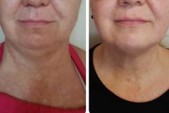 Monoshape-kezeles-Diana-Szepsegstudio-Dnaharaszti-113