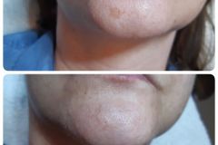 16-Q-YAG-lezeres-Carbon-Peeling-arckezeles-Diana-Szepsegstudio-Dunaharaszti