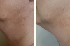 18-Q-YAG-lezeres-Carbon-Peeling-arckezeles-majfolt-halvanyitas-Diana-Szepsegstudio-Dunaharaszti