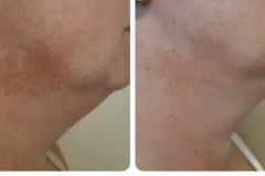 19-Q-YAG-lezeres-Carbon-Peeling-arckezeles-majfolt-halvanyitas-Diana-Szepsegstudio-Dunaharaszti
