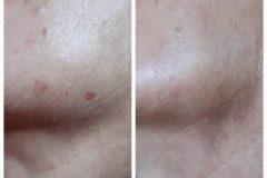 23-carbon-peeling-majfolt-kezeles-Diana-Szepsegstudio-Dunaharaszti