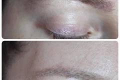 16-tetovalas-eltavolitas-Diana-Szepsegstudio-Dunaharaszti