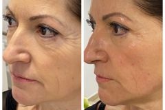 21-Vakuumos-tus-mezoterapia-Diana-Szepsegstudio-Dunaharaszti