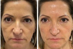 23-Vakuumos-tus-mezoterapia-Diana-Szepsegstudio-Dunaharaszti