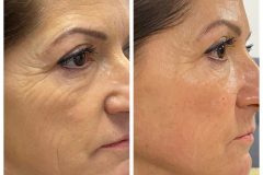 24-Vakuumos-tus-mezoterapia-Diana-Szepsegstudio-Dunaharaszti