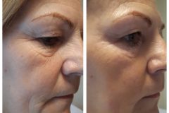 26-Vakuumos-tus-mezoterapia-Diana-Szepsegstudio-Dunaharaszti