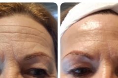 27-Vakuumos-tus-mezoterapia-Diana-Szepsegstudio-Dunaharaszti