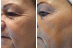 28-Vakuumos-tus-mezoterapia-Diana-Szepsegstudio-Dunaharaszti