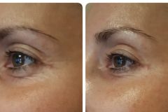 31-Vakuumos-tus-mezoterapia-Diana-Szepsegstudio-Dunaharaszti