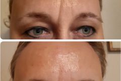 31-mezoterapia-Diana-Szepsegstudio-Dunaharaszti