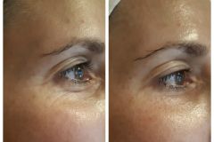 32-Vakuumos-tus-mezoterapia-Diana-Szepsegstudio-Dunaharaszti