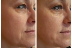 32-mezoterapia-Diana-Szepsegstudio-Dunaharaszti