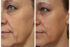 33-mezoterapia-Diana-Szepsegstudio-Dunaharaszti