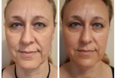 34-mezoterapia-Diana-Szepsegstudio-Dunaharaszti