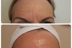 35-Vakuumos-tus-mezoterapia-Diana-Szepsegstudio-Dunaharaszti