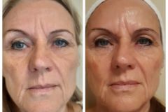 36-Vakuumos-tus-mezoterapia-Diana-Szepsegstudio-Dunaharaszti