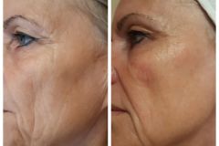 37-Vakuumos-tus-mezoterapia-Diana-Szepsegstudio-Dunaharaszti