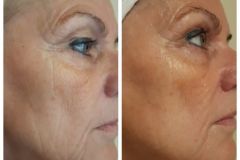 38-Vakuumos-tus-mezoterapia-Diana-Szepsegstudio-Dunaharaszti